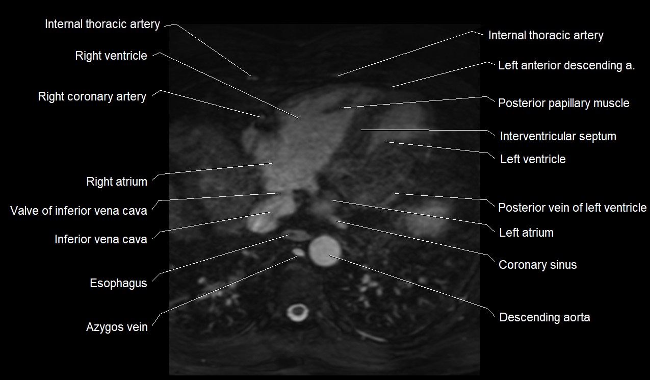 MRI heart coronary arteries and coronary veins anatomy axial image 35.jpg